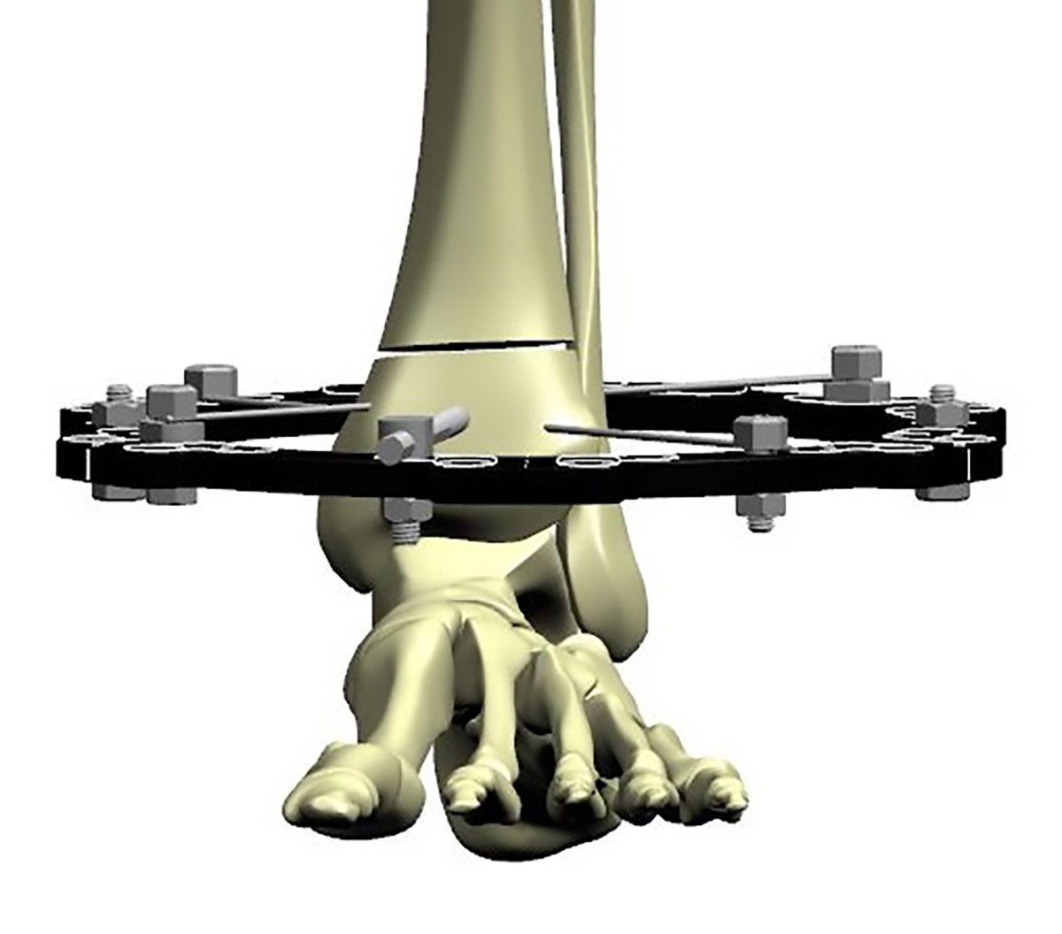 distal tibial fractures figure 3d