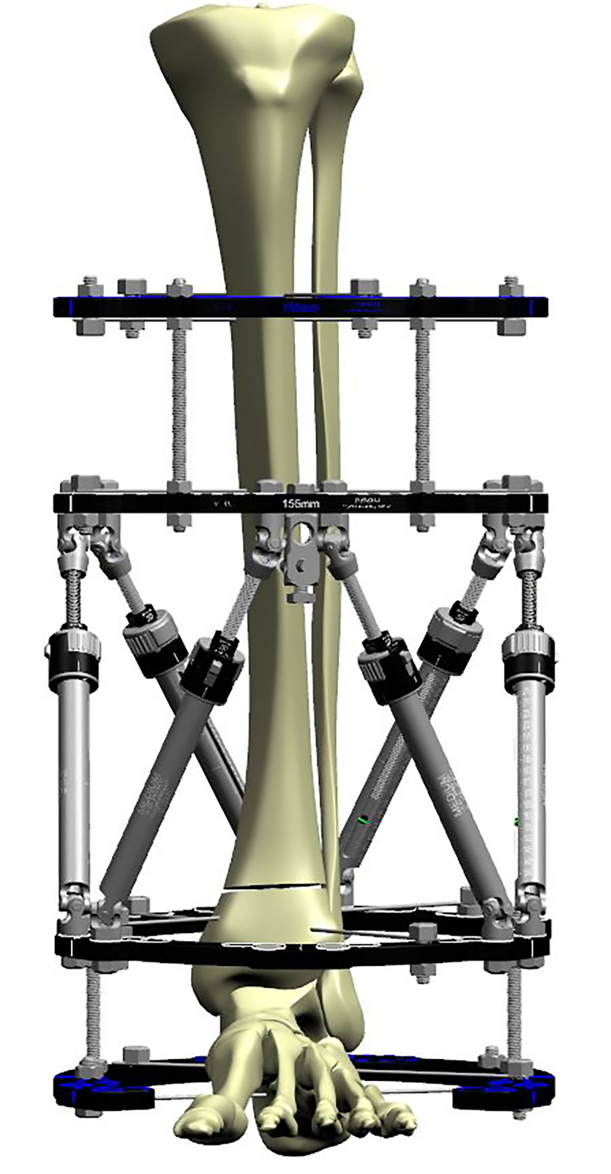 distal tibial fractures figure 4b