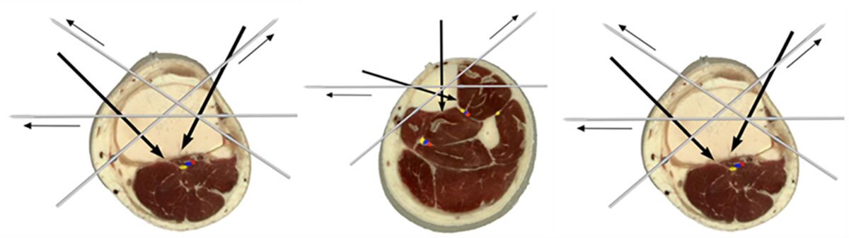 Figure 2
Unaltered figures from Nayagam et al. Safe corridors in external fixation: the lower leg (tibia, fibula, hindfoot and forefoot). Strateg Trauma Limb Reconstr. 2007;2(2-3):105-110.