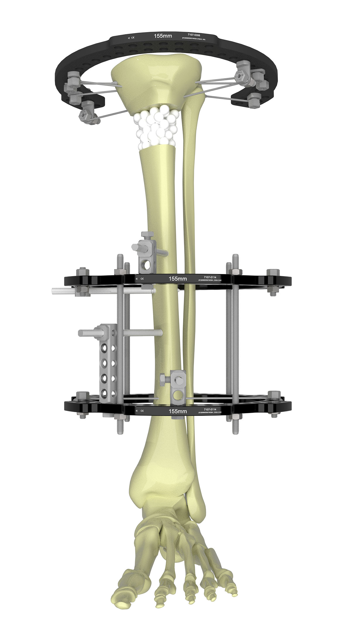 tibial fracture figure 3