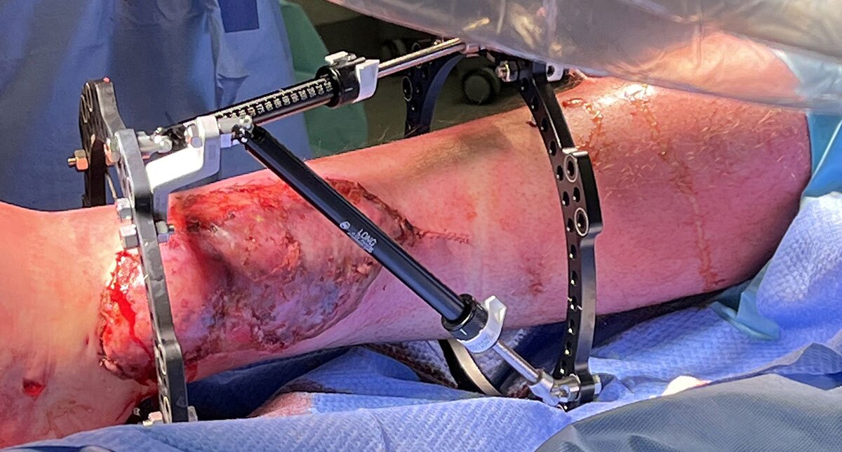 Figure 4c
30mm Step-Off Plate used to create space over wound