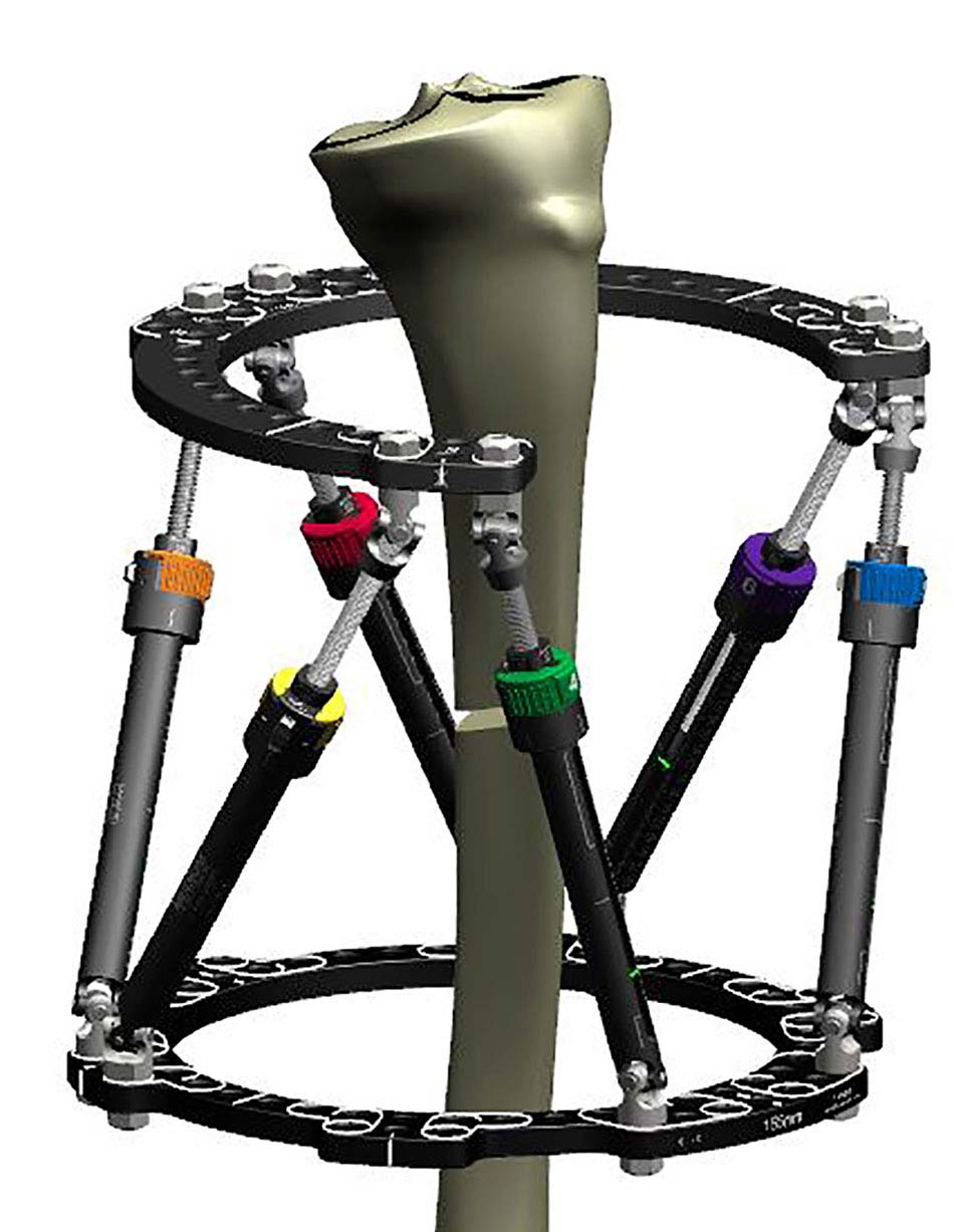 Figure 7a
Proximal 2/3 Ring with 180º Rotary Offset combined with Custom Strut Mount on the Distal Ring to maximize the window over a wound
