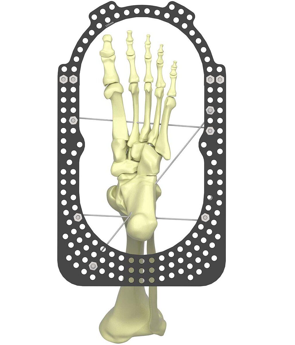 treating equinus figure 2d