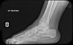 treating equinus figure 1