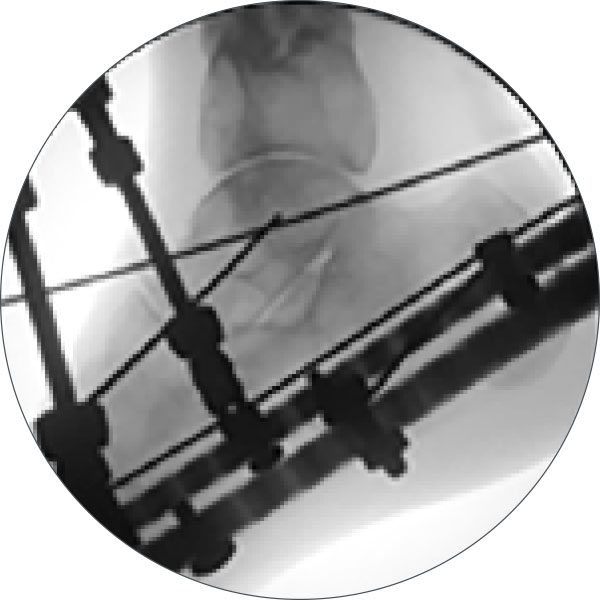 treating equinus figure 4c