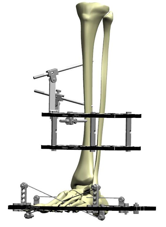 ankle arthrodesis figure 4b