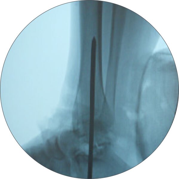 ankle arthrodesis figure 1