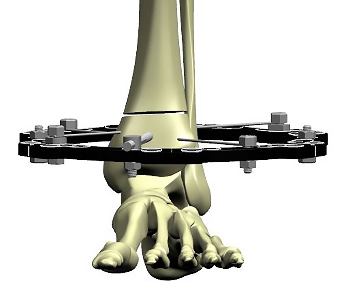distal tibial fractures figure 3d
