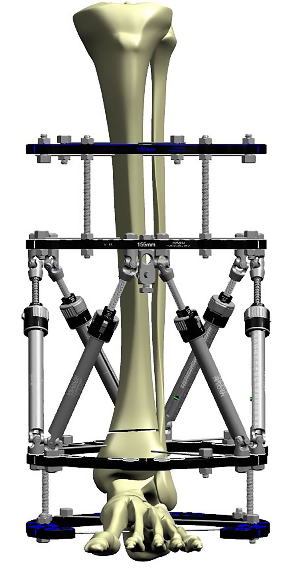 distal tibial fractures figure 4b