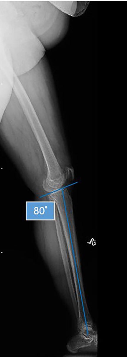 high tibial osteotomy figure 1b