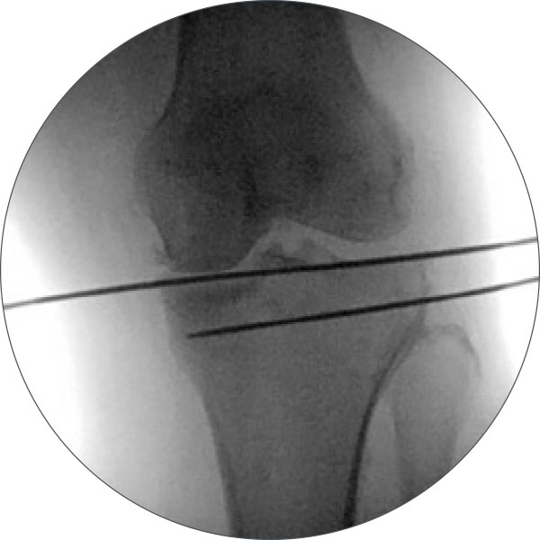 high tibial osteotomy figure 3c