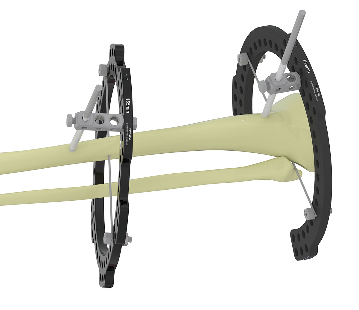 high tibial osteotomy figure 4a