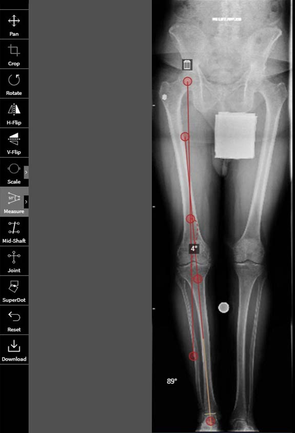high tibial osteotomy figure 6