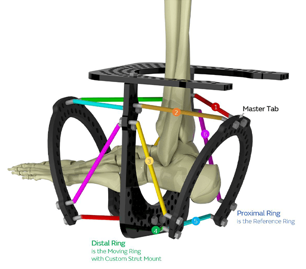 hindfoot frame