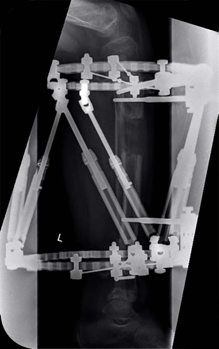 paediatric deformity figure 10