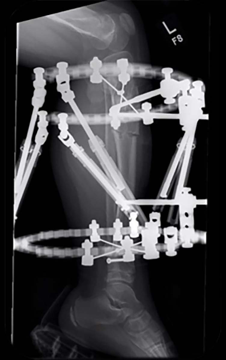 paediatric deformity figure 7