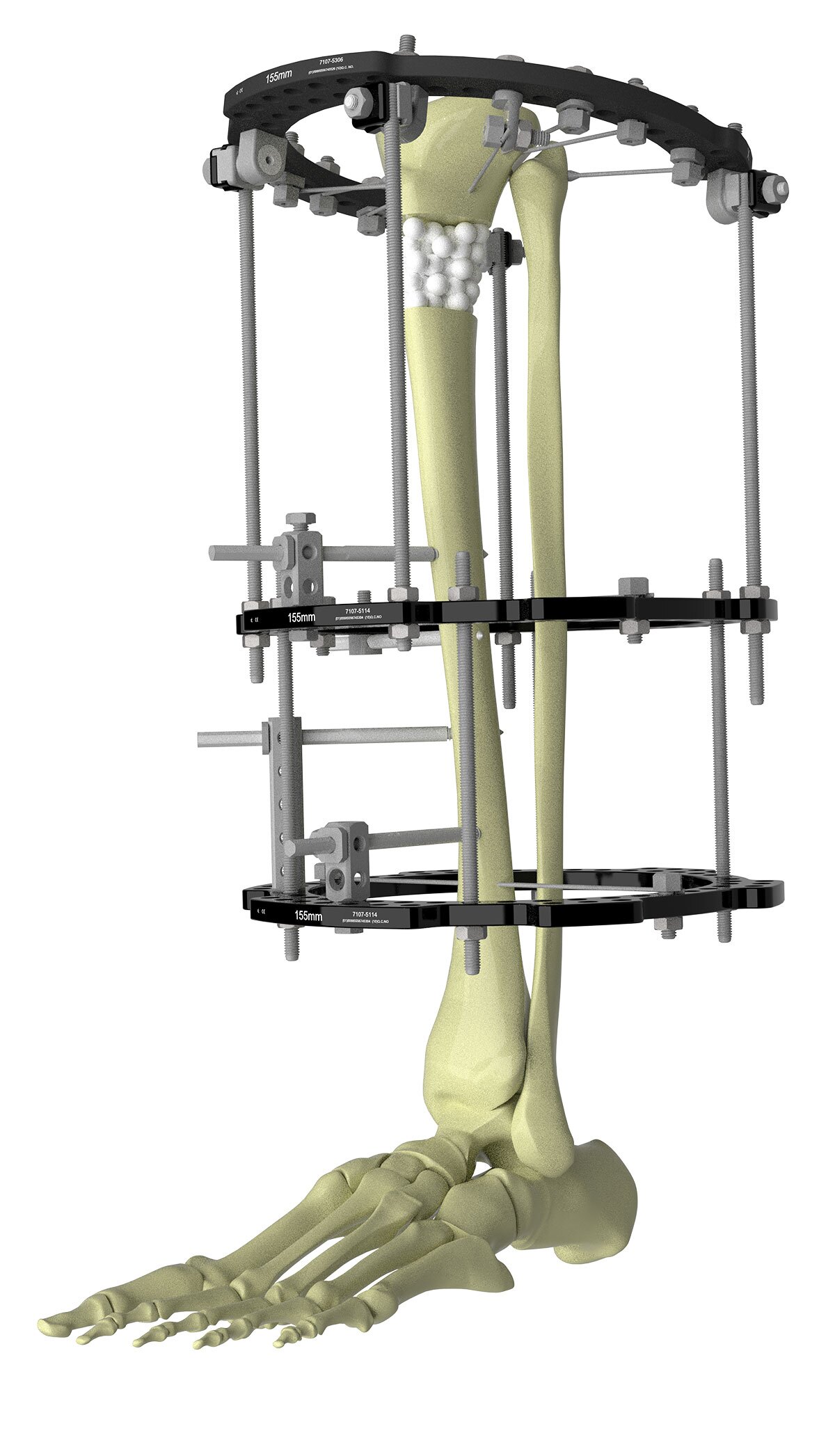 tibial fracture figure 8