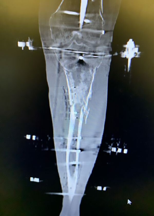 tibial fracture figure 9