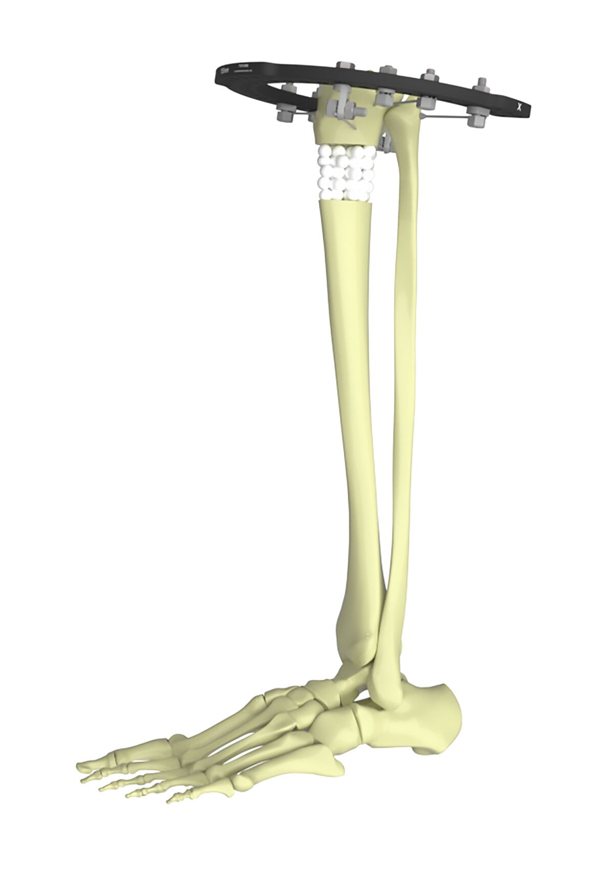 Tibial Fractures figure 1