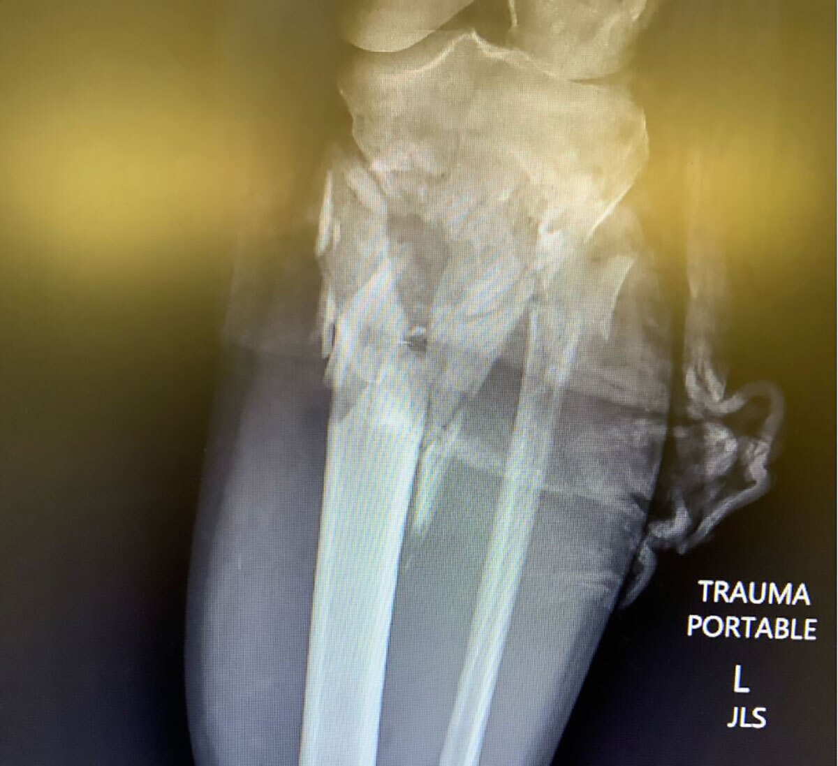 tibial fractures figure 1_1