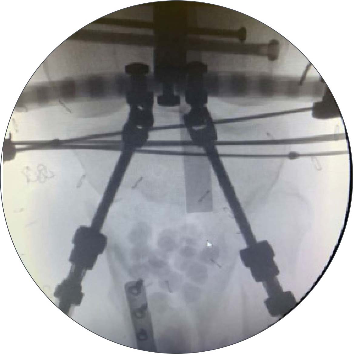 tibial fractures figure 2
