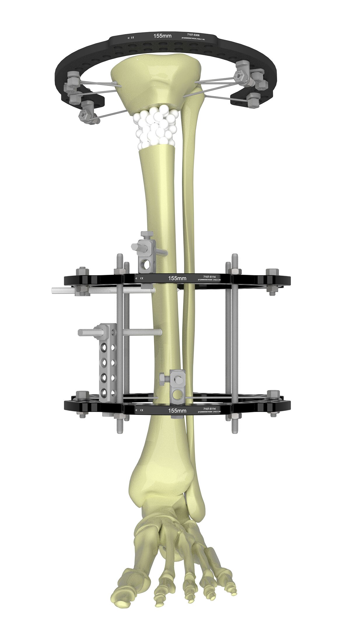 tibial fracture figure 3