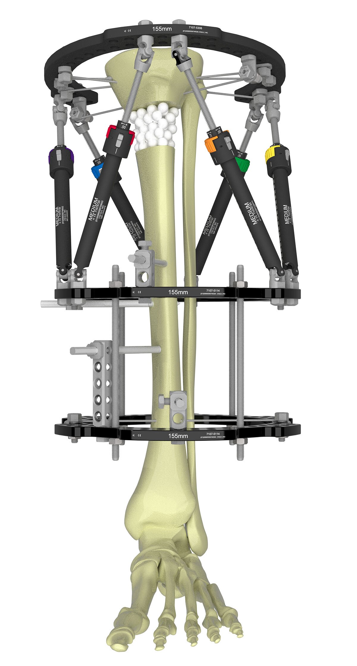 tibial fractures figure 4