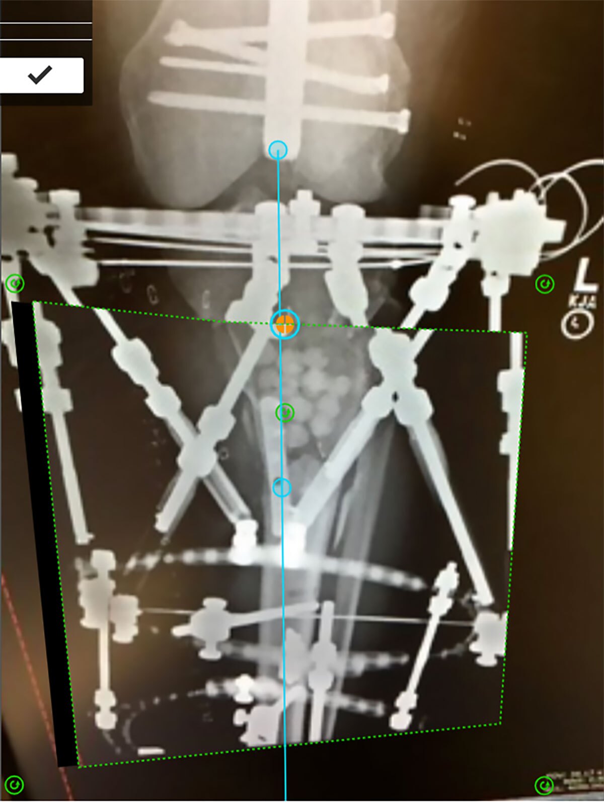 tibial fractures figure 6a