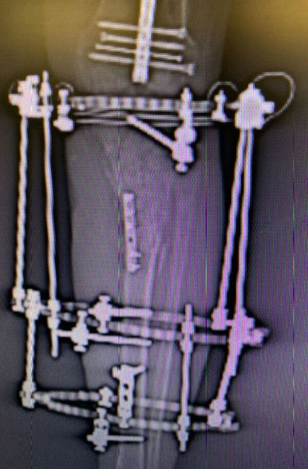tibial fractures figure 7