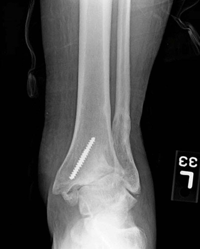 Post-traumatic OA with 20-30° varus