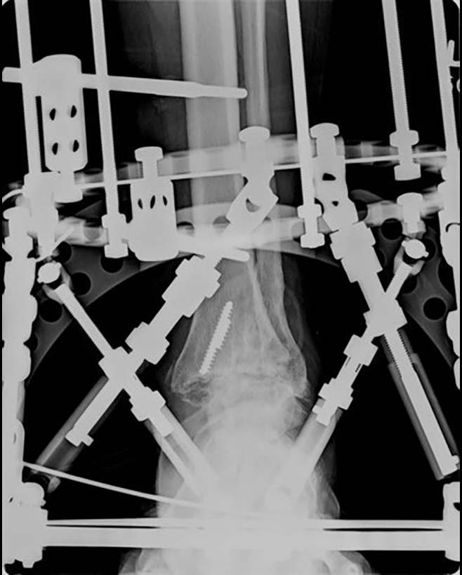 TSF◊ applied, compression
started post-op day 5