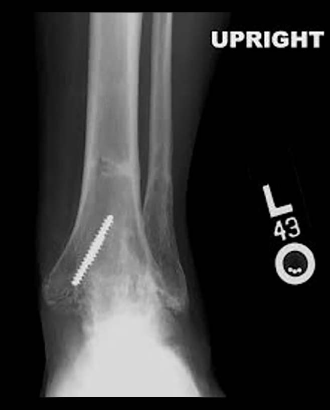Patient at 2 years post-fusion