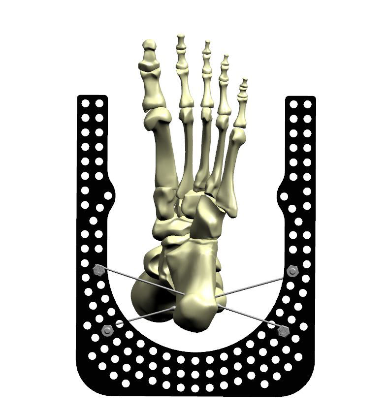 ankle arthrodesis figure 2a