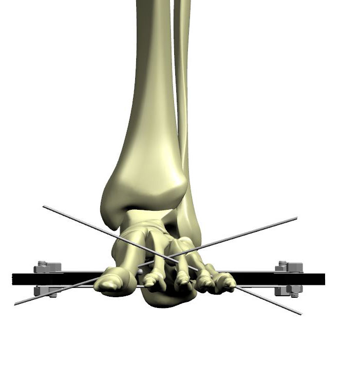 ankle arthrodesis figure 2b
