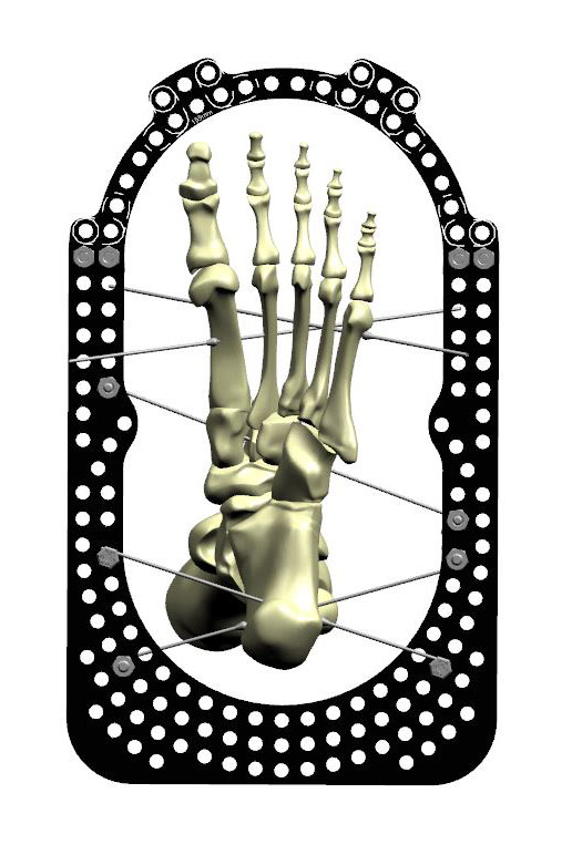 ankle arthrodesis figure 2c