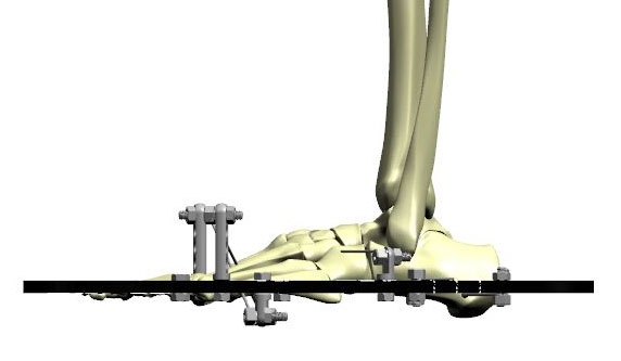 ankle arthrodesis figure 2d