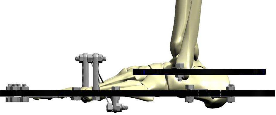 ankle arthrodesis figure 3a