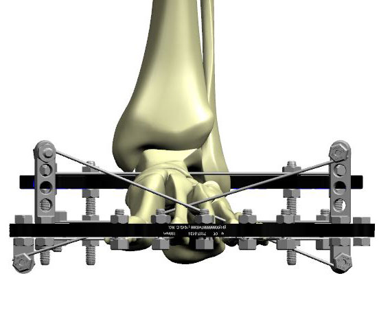 ankle arthrodesis figure 3b