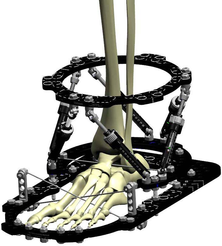 ankle arthrodesis figure 3c