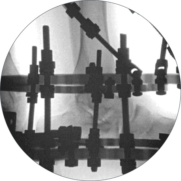 ankle arthrodesis figure 3d