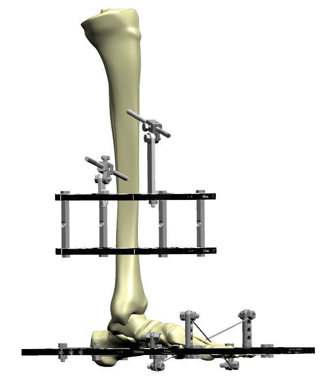 ankle arthrodesis figure 4a