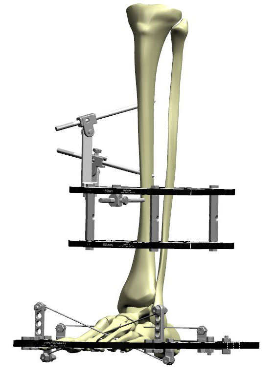 ankle arthrodesis figure 4b