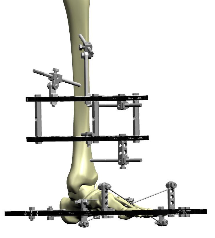 ankle arthrodesis figure 5a