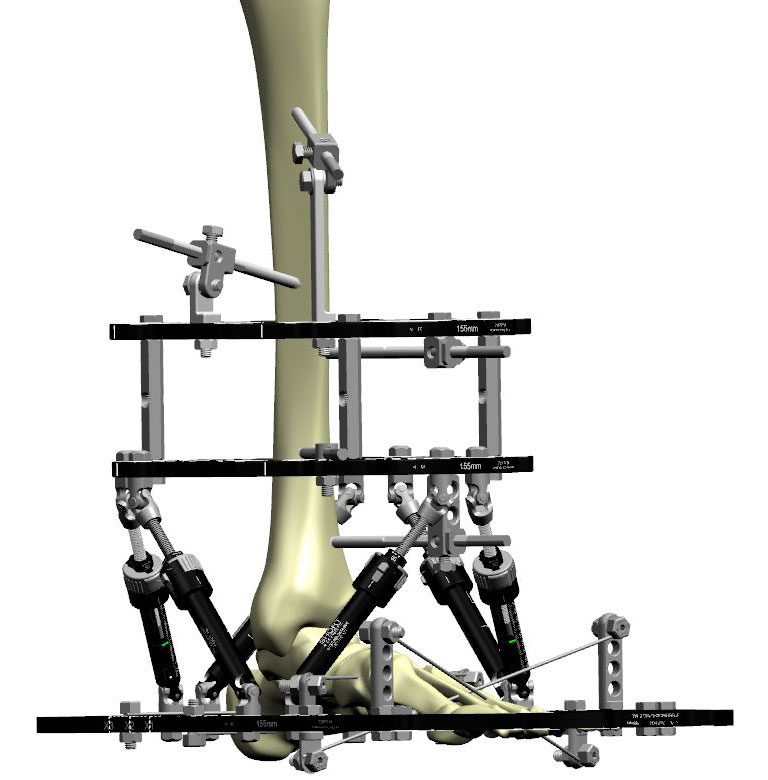 ankle arthrodesis figure 5b