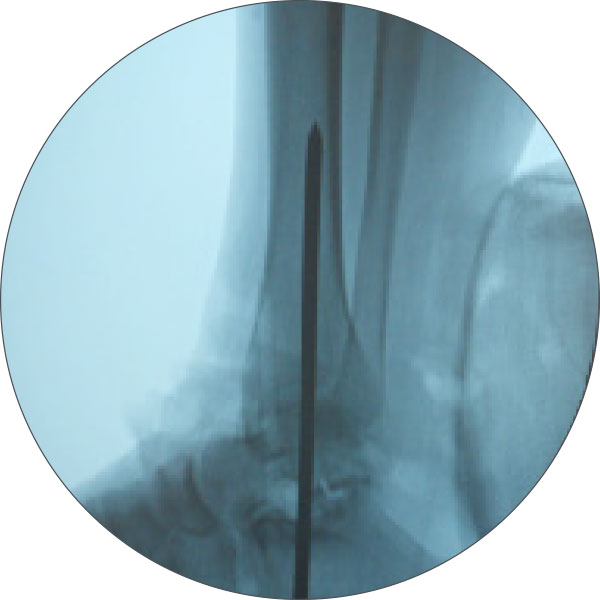 ankle arthrodesis figure 1