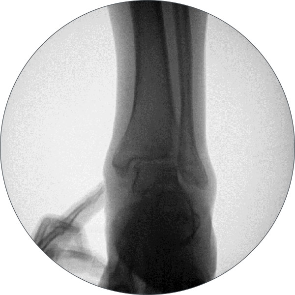 ankle arthrodesis