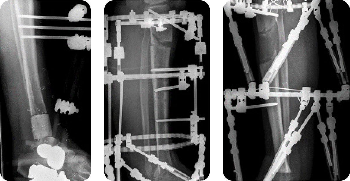 Bifocal ankle fusion and lengthening, using a hybrid TSF and classic Ilizarov lengthening rods proximally (left) or “stacked TSF” (right).