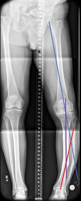 bifocal case example 3
