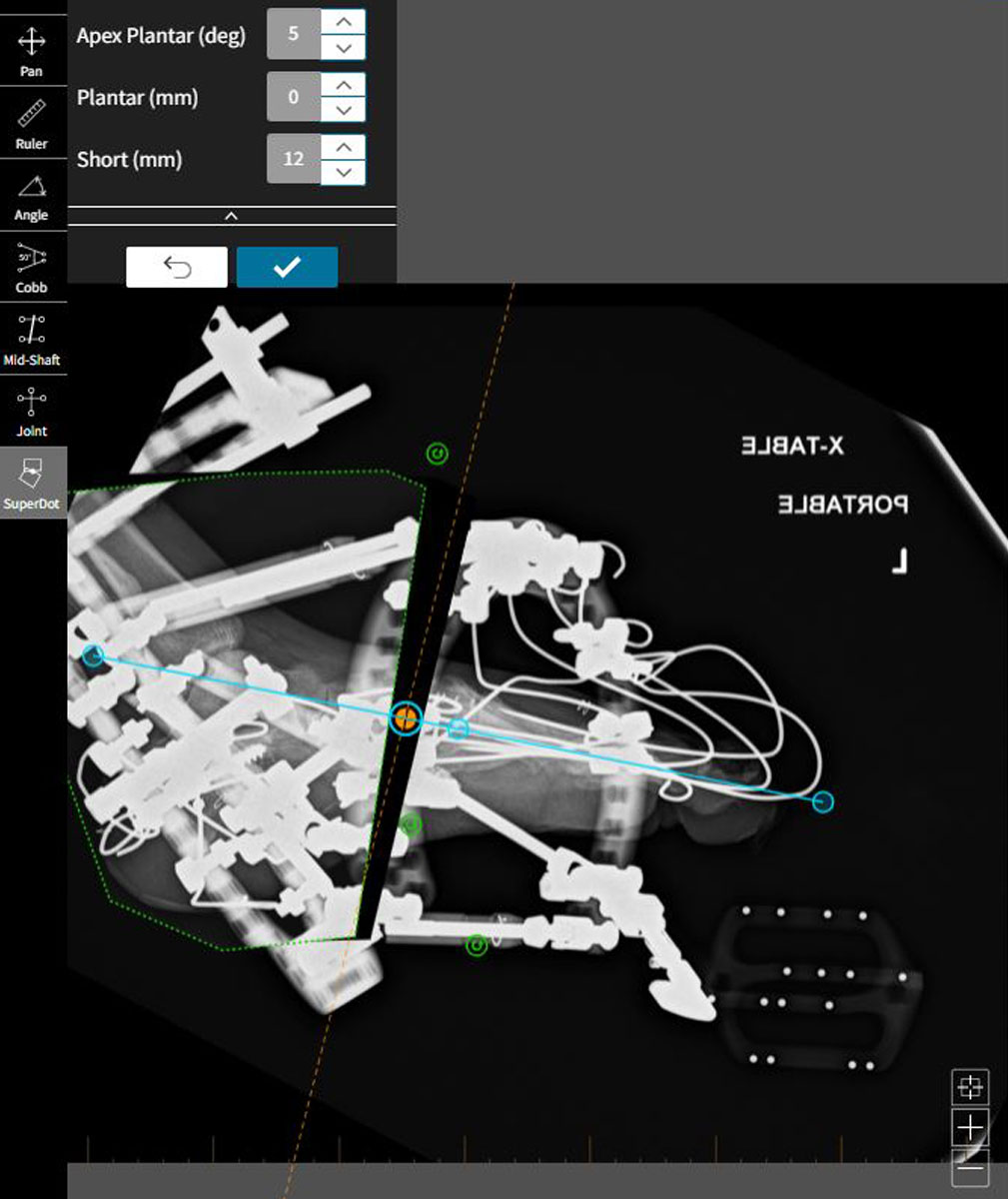 deformity calculations 2