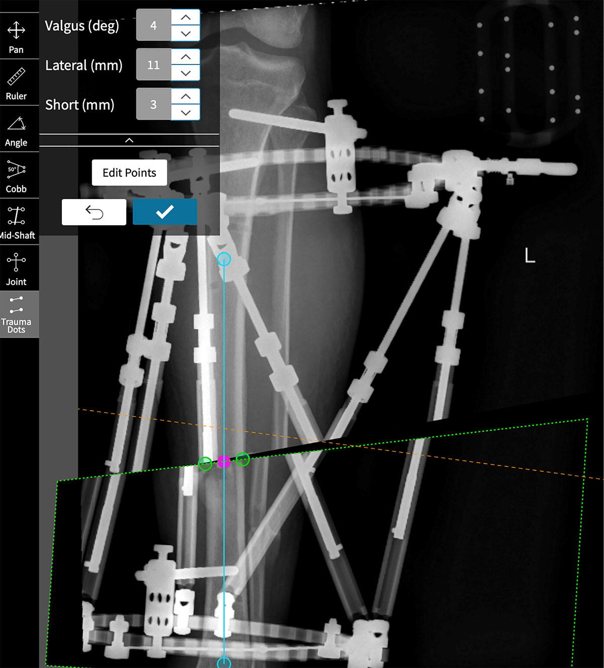 deformity reduction figure 1